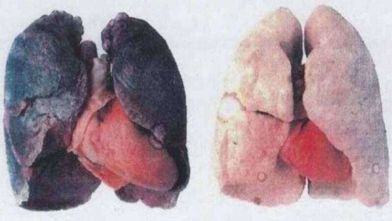 Many die from chronic alcoholic lung damage (left)