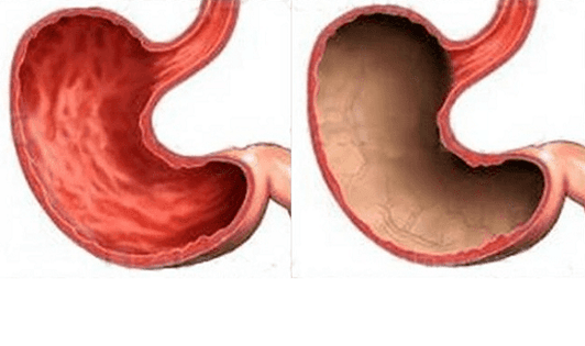 Ulcers, gastritis, cancer and other pathologies of the stomach (right), the appearance of which is caused by alcohol. 